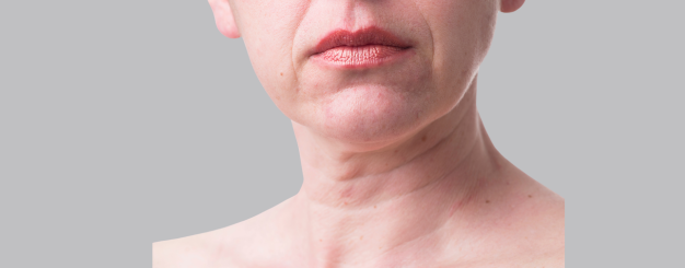 preenchimentos-de-sulcos-bigode-chines-rugas-profundas-